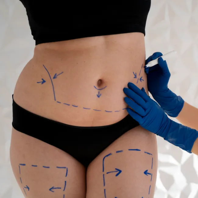 Excellence in Tummy Tuck in Turkey