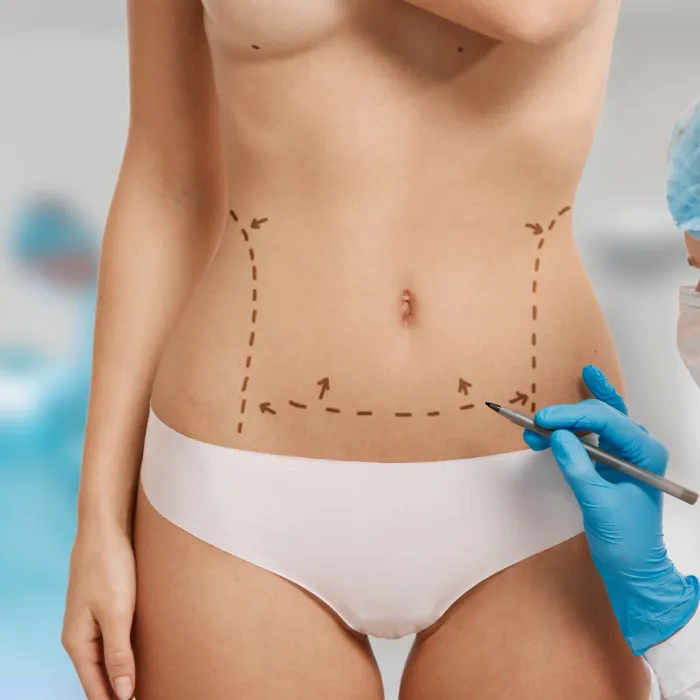 Tummy Tuck