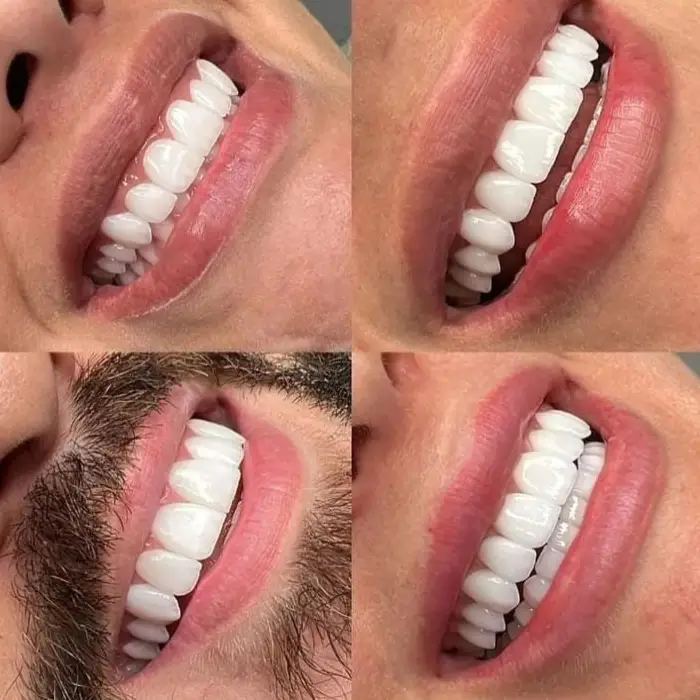 Custom Dental Veneers