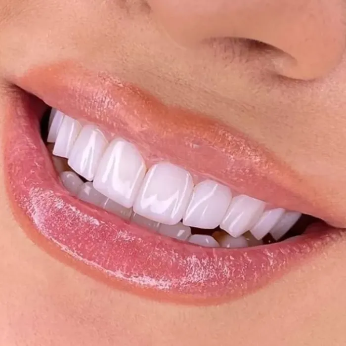 Professional Teeth Whitening