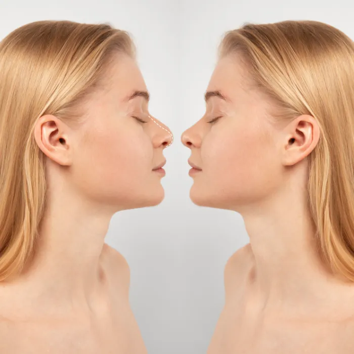 Rhinoplasty